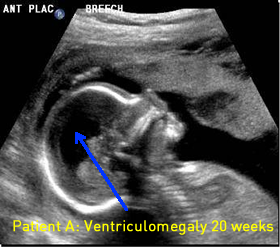 20 week image of fetal spine