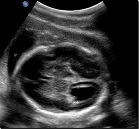 fetal border linevent image