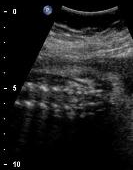 normal scan planes when assessing spina bifida