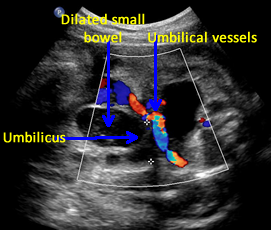 dilated herniated fetal bowe
