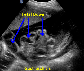 absent fetal bowel membranous covering