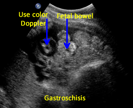 Color Doppler is needed to distinguish umbilical cord vessels
