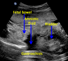 fetal echogenic rings are evident