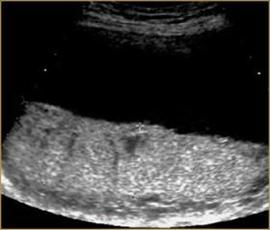 abnormal placenta ultrasound images