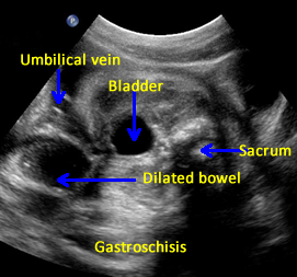 relationship between dilated bowel and fetal pelvic anatomy