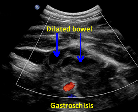 fetal bowel NT