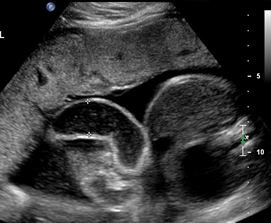 Transverse views of fetal abdomen
