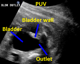 1.PUV.bld.outletobst2.