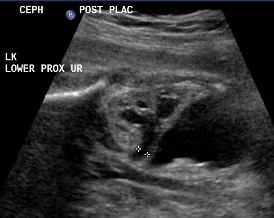 10.loPo.prox.ureter.3.2mm