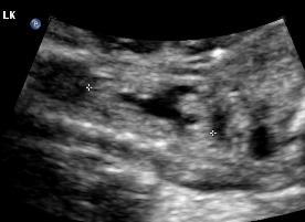 10PUV.enlarg.dyspl.LK