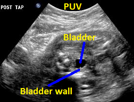 11.Posttap..95cm.thickblad.wall