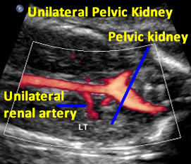 20.1-wksUnilateral.pelvic