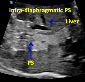 long mass by fetal liver