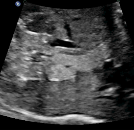 echogenic nature of the mass by fetal liver