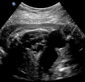 8.PUV.dil.blad.ureter.