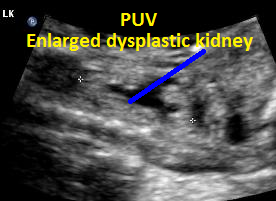 9.PUV.enlarg.dyspl.LK