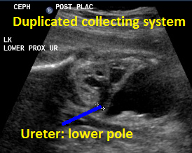 9.loPo.prox.ureter.3.2mma