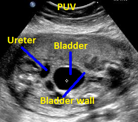 Dil.blad.dil.ureter