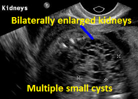 Multiple small cysts1