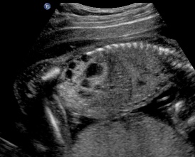 R.Sag.MCDK.echogenic