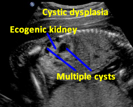 R.Sag.cysdyspd.echogenic