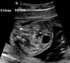 rtpelkidney.2.7mm.ureter