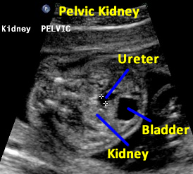 rtpelkidney.2.7mm.ureter