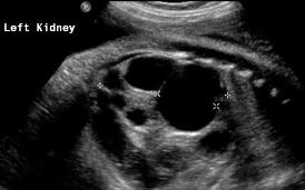 Contralateral kidney is normal