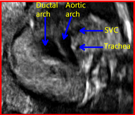 Normal Ultrasound: Fetal Heart 2.270.fn3vt