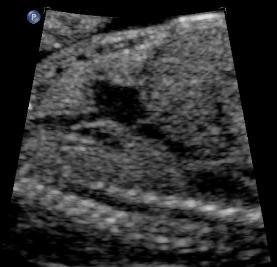transducer longitudinal to the right of the heart and parallel to the fetal spine