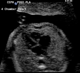 right atrium with the leaflets of the tricuspid valve