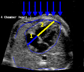 ultrasound beam which is directed transversely to the fetal chest