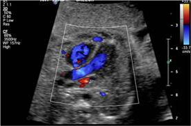 Color Doppler demonstrating the left ventricular outflow tract