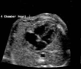 left ventricle occupies most of the left cardiac border