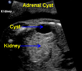 Oblique view of fetal cyst