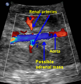 fetal adrenal gland mass coronal