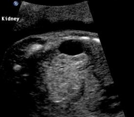 Cyst extrinsic to the right kidney of adrenal origin