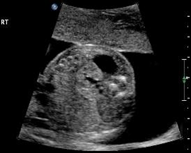 Extrins.Cyst.19.6wks.1.7x1.3cm.sup.lf.kdi