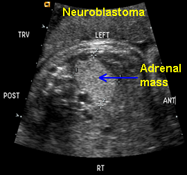 mass on kidney and adrenal gland