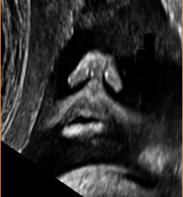 15.Fn2.Coronal nose-mouth