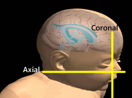 25.Approx.coronalaxial.view_