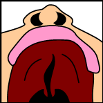 38.Cleftpalate3