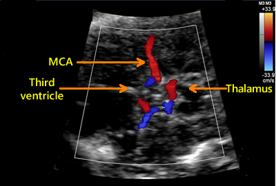 MCA Doppler and Fetal Anemia Guidance by Dr. Emanuel Gaziano MD