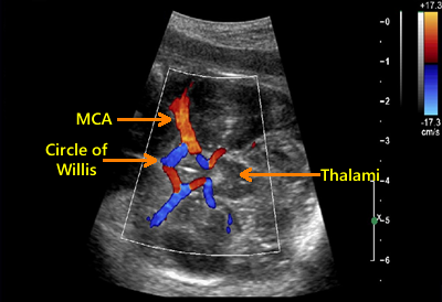 MCA Doppler and Fetal Anemia Guidance by Dr. Emanuel Gaziano MD